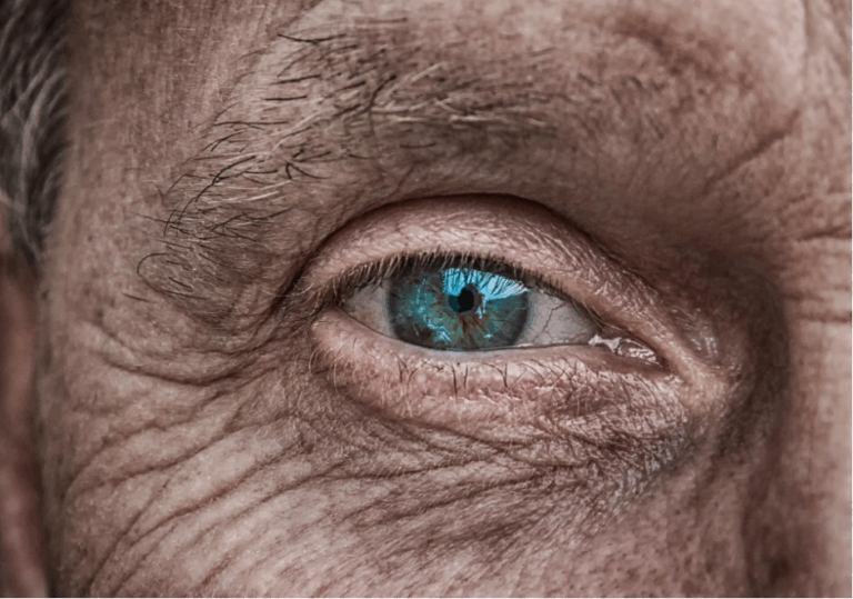 After Cataract Surgery Care