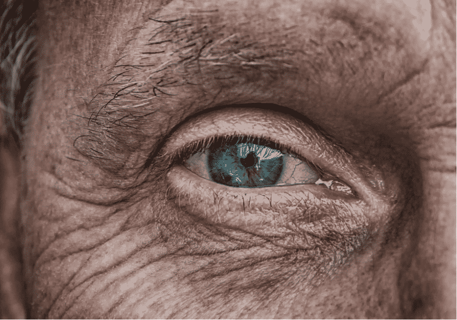 After Cataract Surgery Care