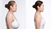 Does Medicare Cover Breast Reduction