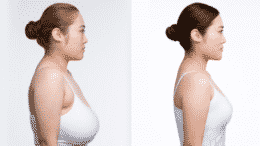 Does Medicare Cover Breast Reduction