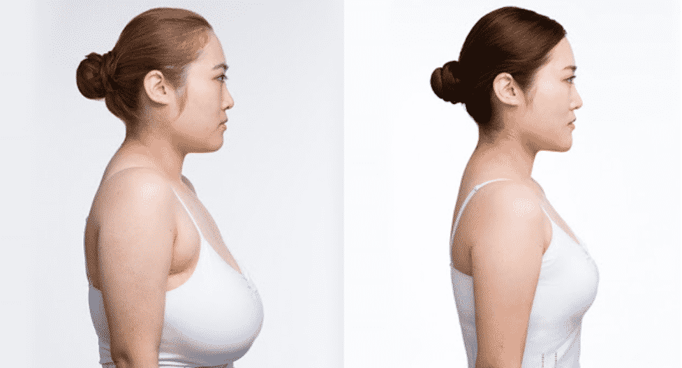 Does Medicare Cover Breast Reduction