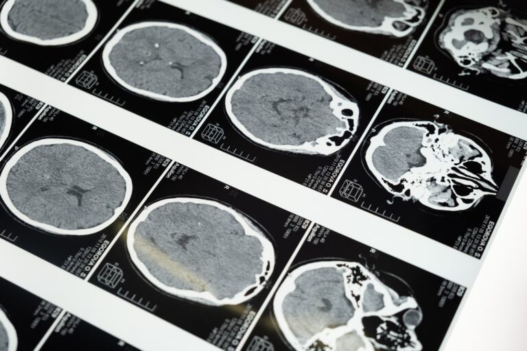 Neurology Grants