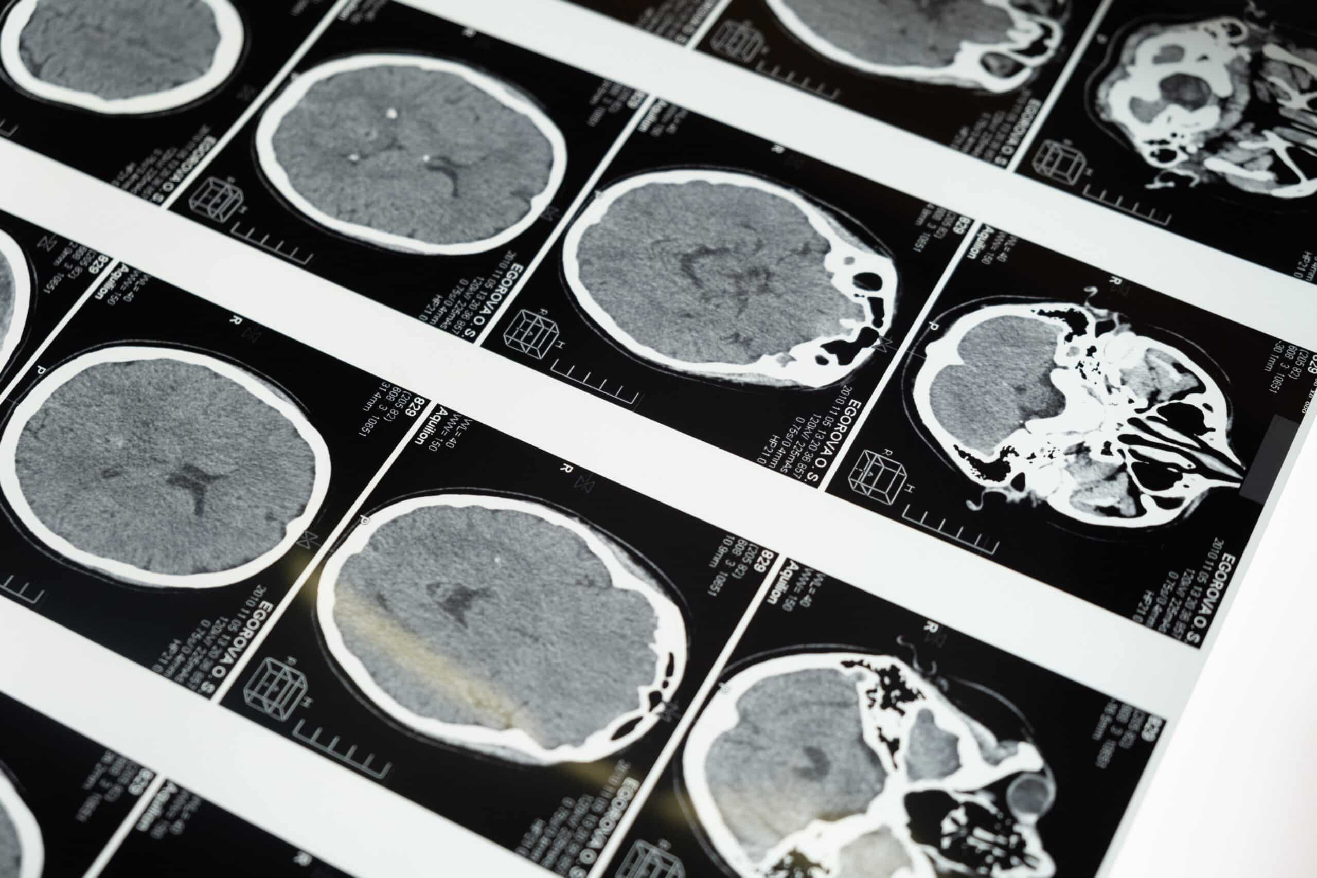 Neurology Grants