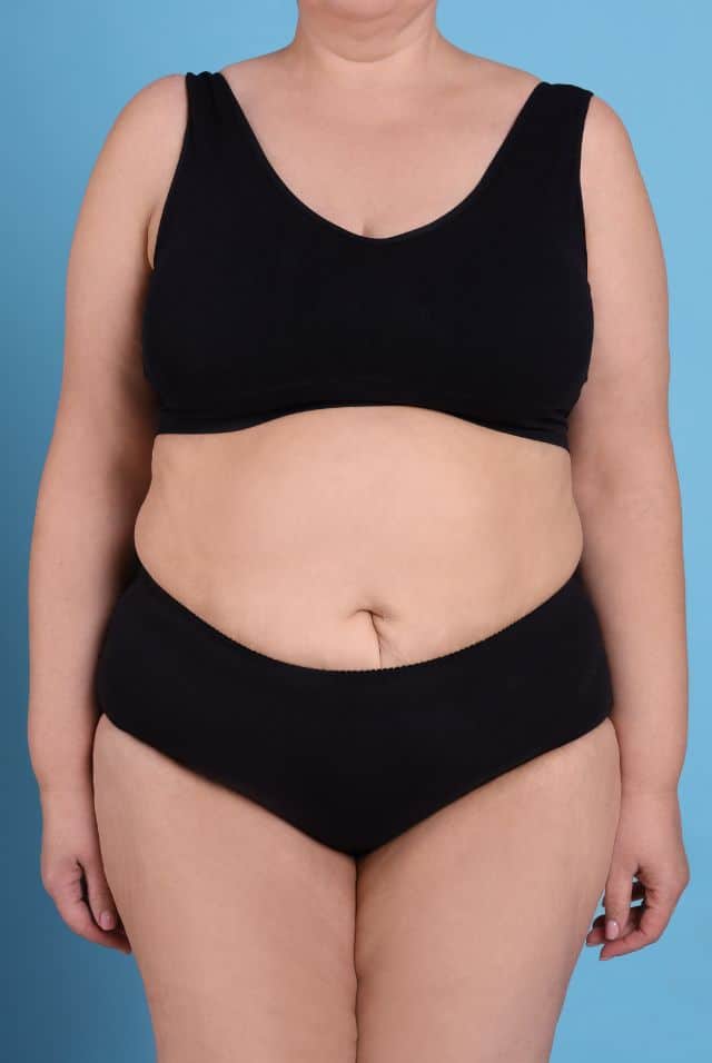 Bariatric Surgery Requirements