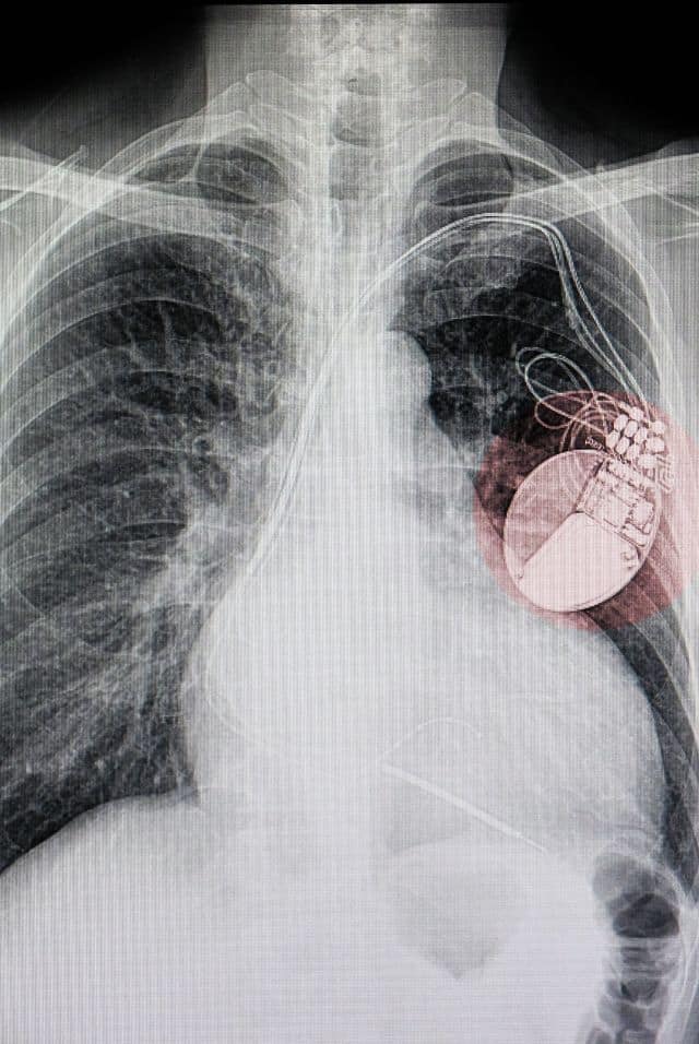 Can you have a Heart Attack with a Pacemaker or Defibrillator