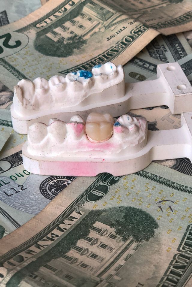 Partial Dentures Vs Implants