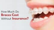 How Much Do Braces Cost Without Insurance