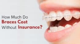 How Much Do Braces Cost Without Insurance