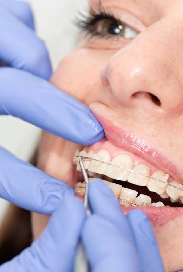 How Much Do Braces Cost Without Insurance 