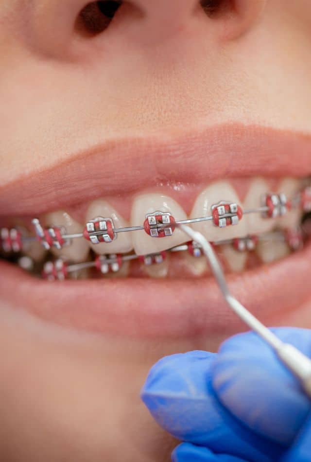 Where Can I Get My Braces Removed for Free