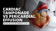 Cardiac Tamponade vs Pericardial Effusion