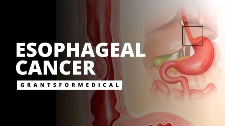 Esophageal Cancer